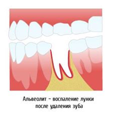 Tratamentul alveolitei - bun stomatologie districtul St. Petersburg Vyborgsky