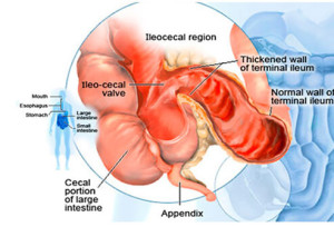 Tratamentul bolii Crohn cu medicamente și metode de remedii folclorice