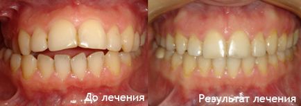 Tratamentul cu un sistem de suport cu îndepărtarea dinților