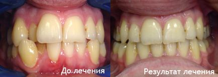 Лікування брекет-системою з видаленням зубів