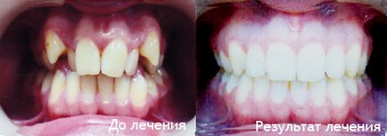 Лікування брекет-системою з видаленням зубів
