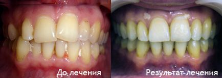 Лікування брекет-системою з видаленням зубів