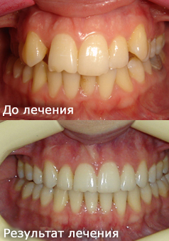 Лікування брекет-системою з видаленням зубів