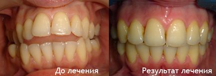 Лікування брекет-системою з видаленням зубів