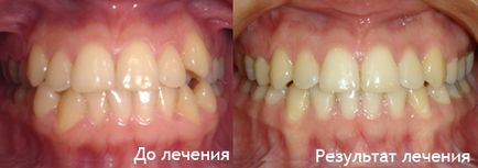 Лікування брекет-системою з видаленням зубів