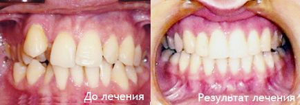 Лікування брекет-системою з видаленням зубів