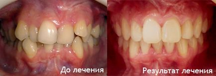 Лікування брекет-системою з видаленням зубів