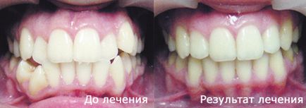 Лікування брекет-системою з видаленням зубів