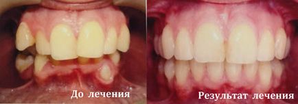 Лікування брекет-системою з видаленням зубів
