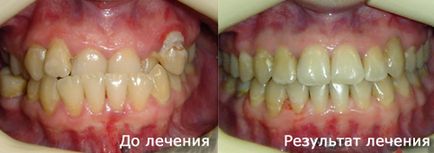 Tratamentul cu un sistem de suport cu îndepărtarea dinților