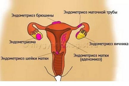 Tratamentul formelor individuale de endometrioză genitală - metode de tratament în ginecologie