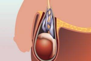 Лікування варикоцеле народними засобами, як вилікувати варикоцеле в домашніх умовах