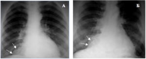 Lipomul unghiului cardio-diafragmatic la dreapta