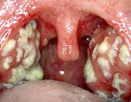 Lugol cu ​​purulente dureri în gât poate fi folosit și nu ajută