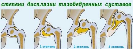 Масаж, вправи і гімнастика при дисплазії тазостегнових суглобів