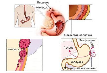 Metastazele în cancerul de stomac sunt principalele căi de răspândire