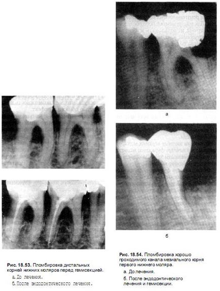 Schimbari morfologice in domeniul furcatiilor - parodontologie, chirurgie parodontala - chirurgie si chirurgie