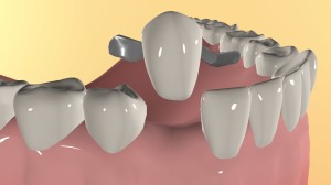 Мостовідний адгезивний протез зубне протезування без обточування, ціни, фото