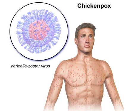 Pot să reapar cu o varicela la o persoană adultă, care sunt simptomele?