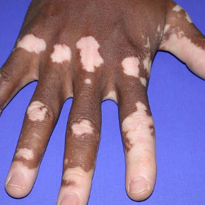 Мармурова шкіра у дорослих (ливедо), мармурова шкіра у дитини