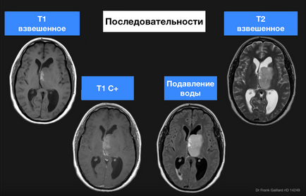 Мрт послідовність - т1 с, flair, stir