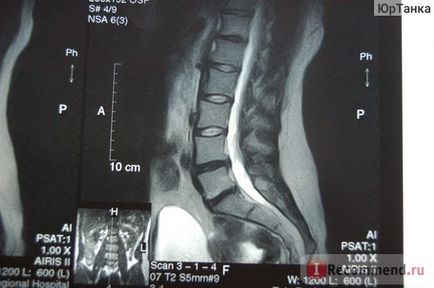 Мрт хребта - «міжхребцева грижа, ретролістез хребця - діагностовано мрт