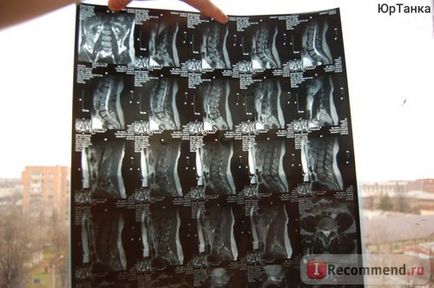 MRI gerinc - „porckorong sérv, csigolya retrolisthesis - diagnosztizált MRI (hernia) MRI gerinc - „porckorong sérv, csigolya retrolisthesis - diagnosztizált MRI