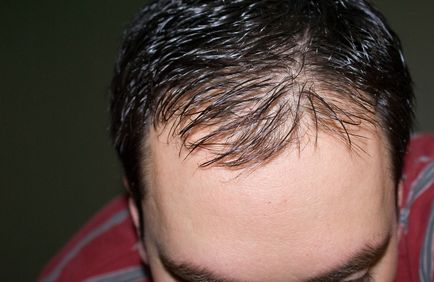 Modelul masculin al alopeciei la diagnosticul și tratamentul femeilor