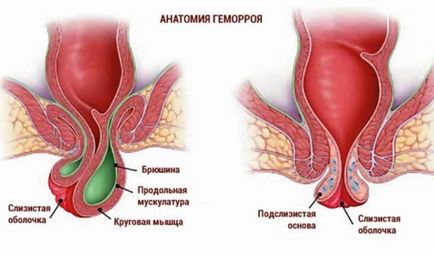Hemoroizi externi la femei - cum arată conurile exterioare și nodurile, ce pot fi tratate