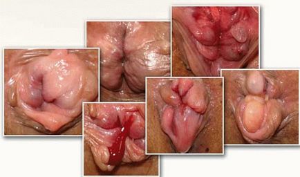 Hemoroizi externi la femei - cum arată conurile exterioare și nodurile, ce pot fi tratate