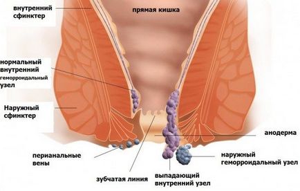 Външни хемороиди в женски снимки - приличат на шишарки и външни компоненти, отколкото може да произведе лечение