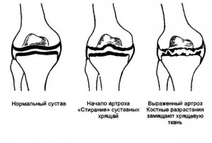 Ванні артрозів в Україні для діагностичних досліджень