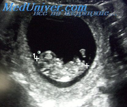 Normál ultrahang 4-6 hetes terhesség