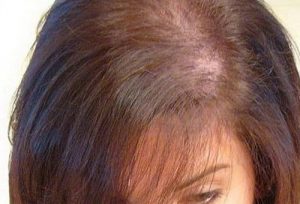Alopecia la femei prin semne de sex masculin și tratament