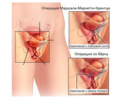 Operații pentru incontinență la femei, în funcție de cauză
