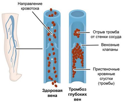 Операція при варикозі види втручання, показання, ускладнення