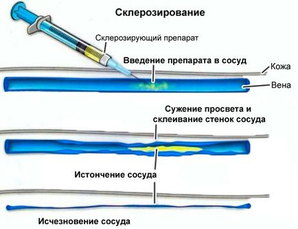 Операція при варикозі види втручання, показання, ускладнення