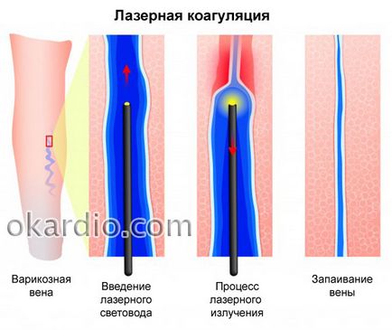 Операція при варикозі види втручання, показання, ускладнення