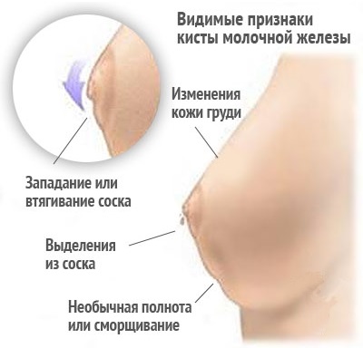 Опухла груди першопричини опухання обох або однієї з грудей