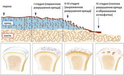 Osteoartroza 1, 2, 3 grade de terapie, fizioterapie