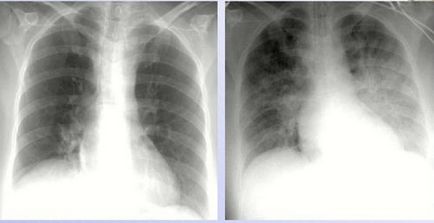 Edem pulmonar Imagine și descriere radiografică cu raze X