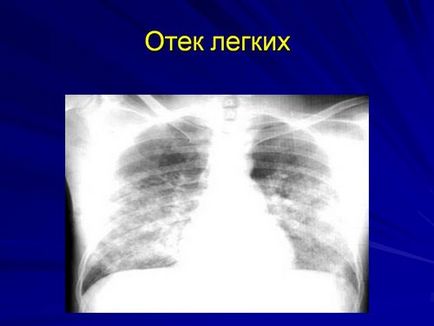 Edem pulmonar Imagine și descriere radiografică cu raze X