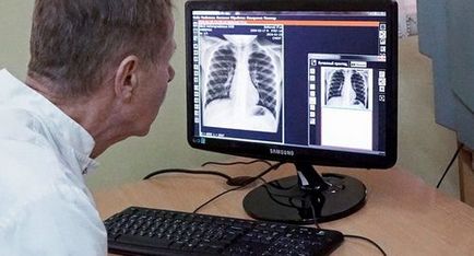 Edem pulmonar Imagine și descriere radiografică cu raze X