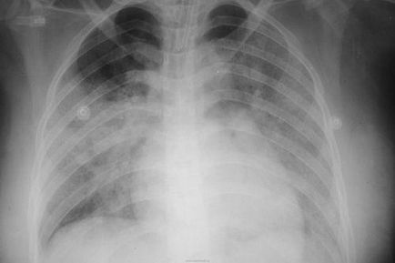 Tüdőödéma X-ray X-ray kép és a leírás