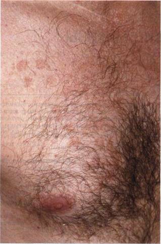 Pityriasis versicolor pityriasis versicolor (pityriasis) chromophytosis chromophytosis