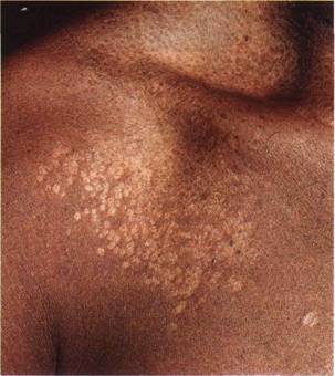 Pityriasis versicolor korpásodás zoster (övsömör) chromophytosis chromophytosis