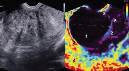 Evaluarea leziunilor uterine prin elastografie în timp real - w