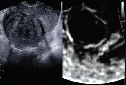 Evaluarea leziunilor uterine prin elastografie în timp real - w
