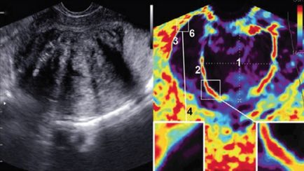 Evaluarea leziunilor uterine prin elastografie în timp real - w