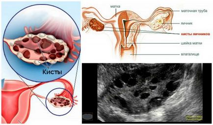 Chistul ovarian chiurar și laparoscopia pentru îndepărtarea acestuia